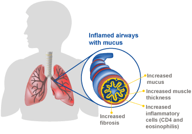 increased narrow and mucus filled lungs during an asthma attack 