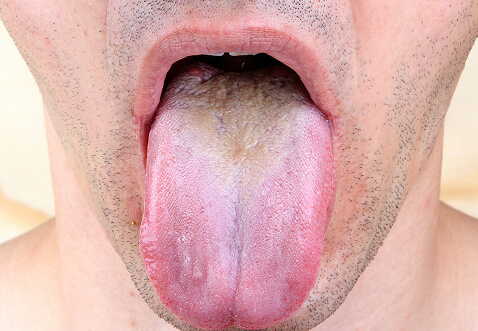 oral thrush