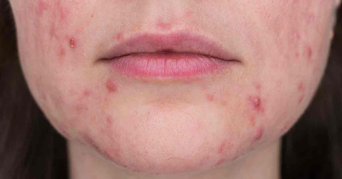 A close-up of a woman’s face with papulopustular rosacea