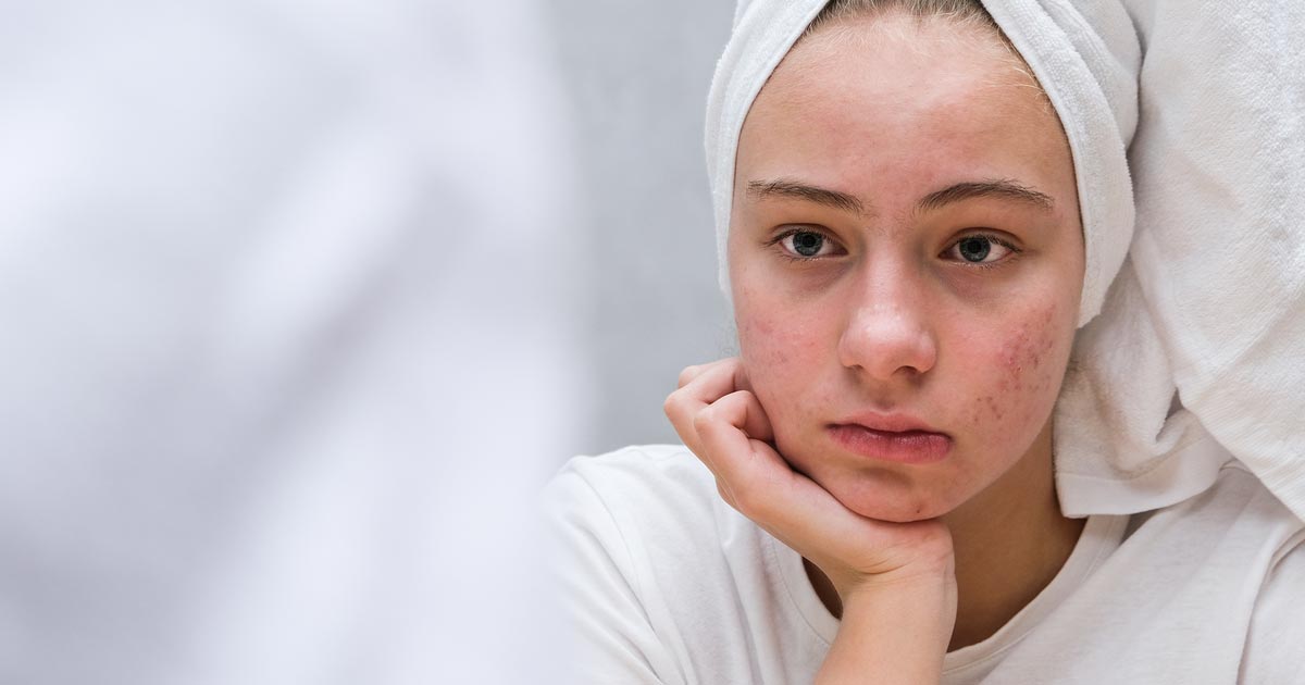 Young girl with acne looking sadly at herself in the mirror.