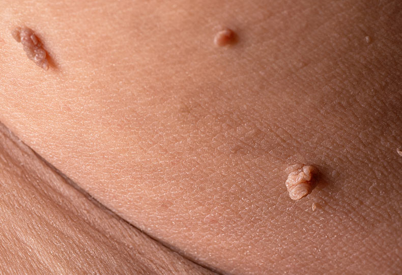 Skin tags on the body