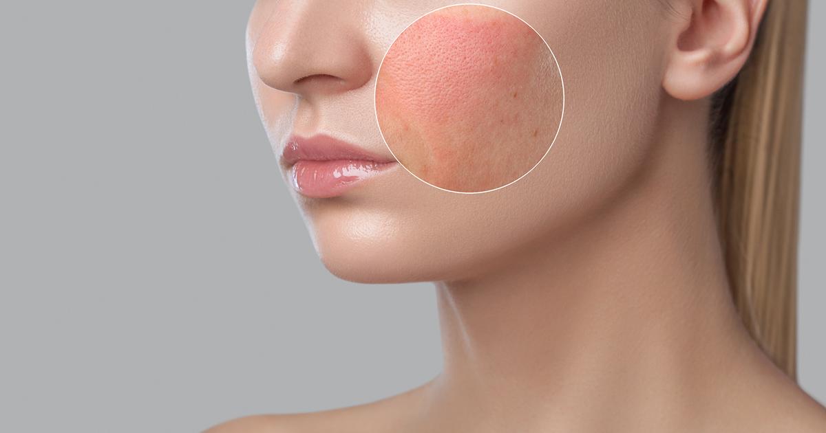 Close up of young woman’s cheek with rosacea.
