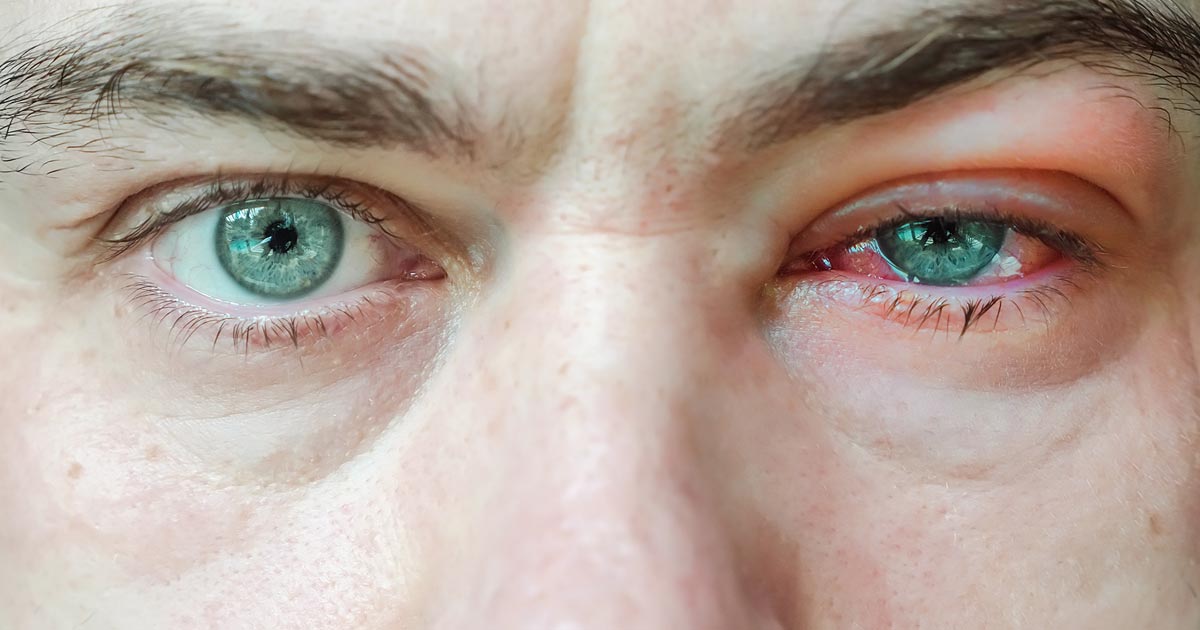 Lähikuva miehestä, jolla on sidekalvotulehdus toisessa silmässä.