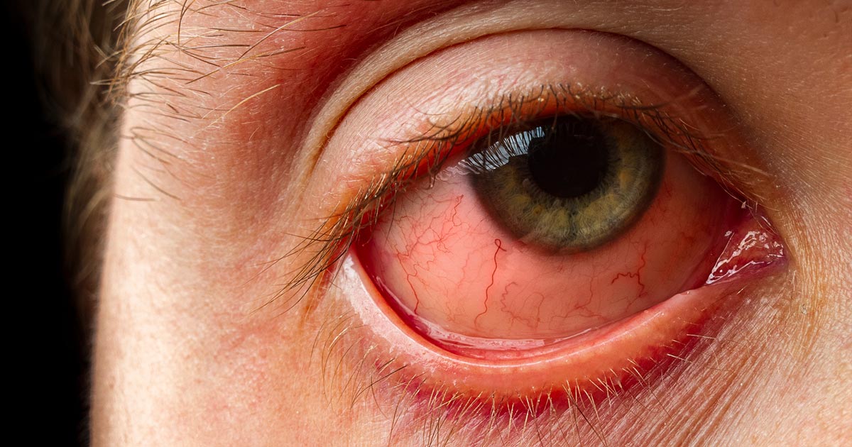 Lähikuva miehestä, jolla on sidekalvotulehdus.