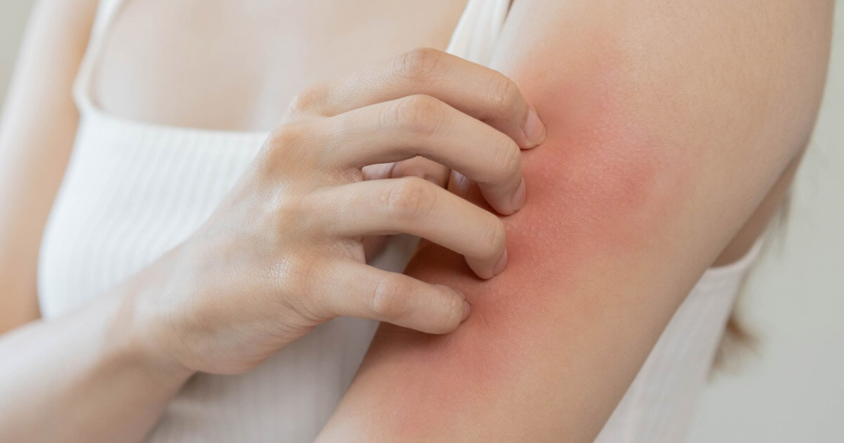 Nainen pitelee kiinni olkavarrestaan, jossa on punaista ihottumaa.