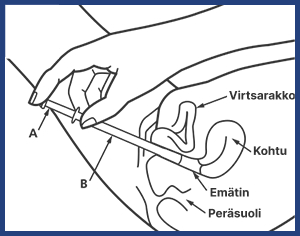 Infografiikka Canesten-asettimen käytöstä.