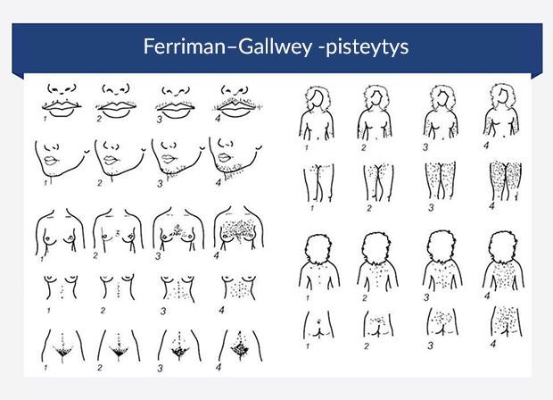 Grafiikka, joka esittelee Ferriman–Gallwey -pistejärjestelmää