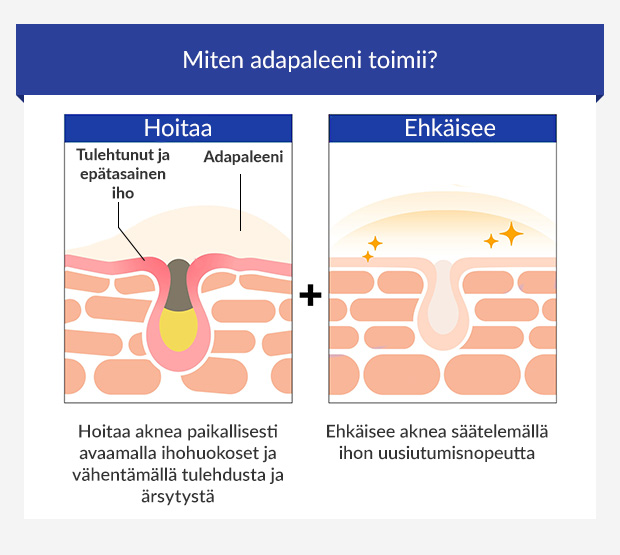 Infografiikka adapaleenin tehosta aknen hoidossa ja ehkäisyssä.