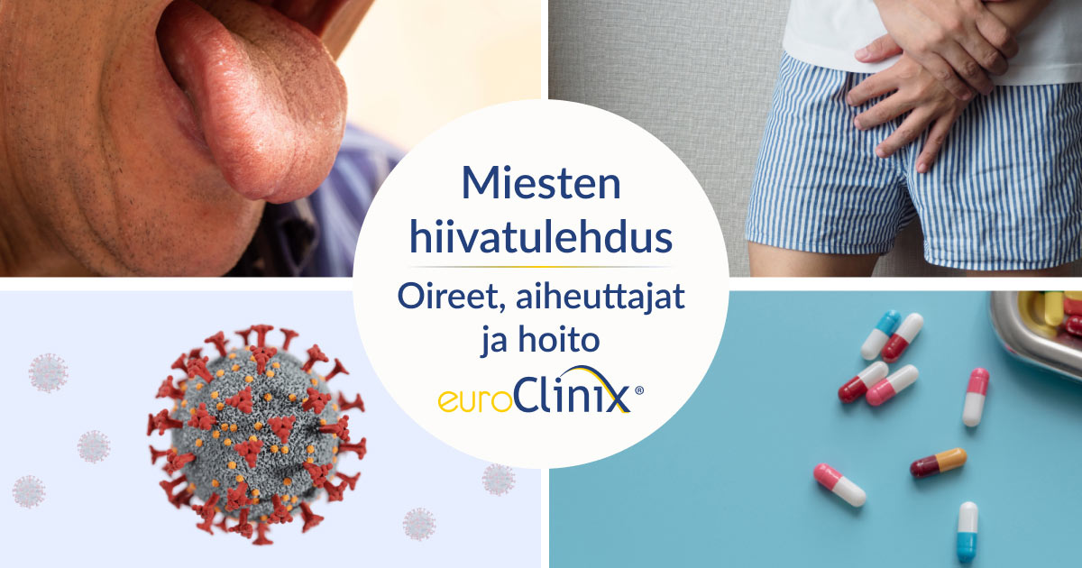 Miesten hiivatulehduksen oireet, aiheuttajat ja hoito