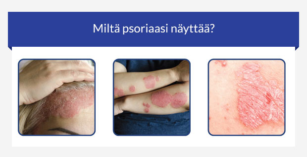 Kuvituskuva psoriaasin kolmesta erilaisesta oireesta