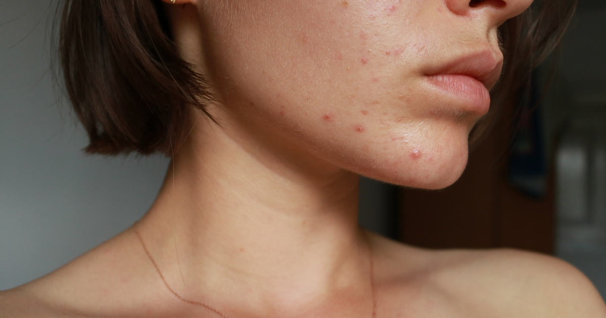 Gros plan sur le visage d’une femme atteinte d’acné.