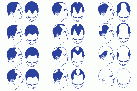 Male pattern baldness