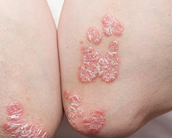 Gros plan d’une éruption de psoriasis sur les coudes.