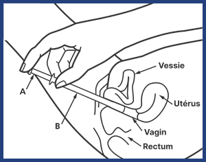 Infographie montrant comment insérer l'applicateur