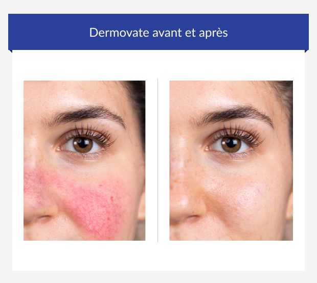 Avant et après l'utilisation de Dermovate