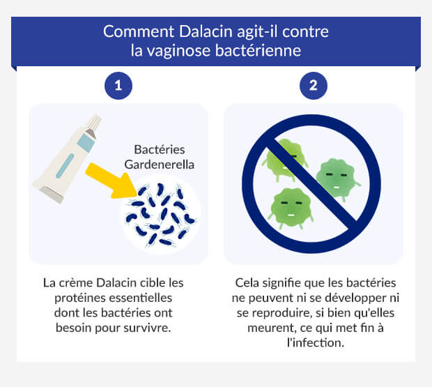 Grafik zeigt, wie Sobelin-Creme bakterielle Vaginose behandelt.