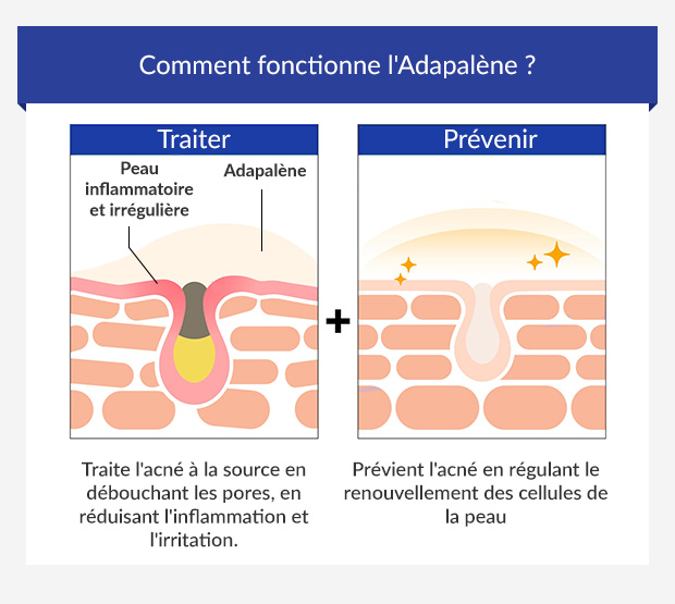 Infographie montrant comment l'adapalène traite et prévient l'acné