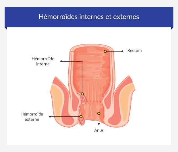 Cabinet St Raphael - Hémorroïdes : externes ou internes ? Les hémorroïdes  externes Elles apparaissent sous la peau à l'orifice de l'anus. Elles  peuvent causer une enflure dans la région. Elles sont