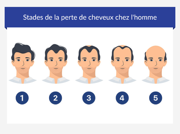 Graphique illustrant les étapes de la perte de cheveux chez l'homme