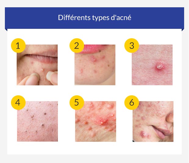 Guide de l'acné — Symptômes, prévention et traitement • euroClinix