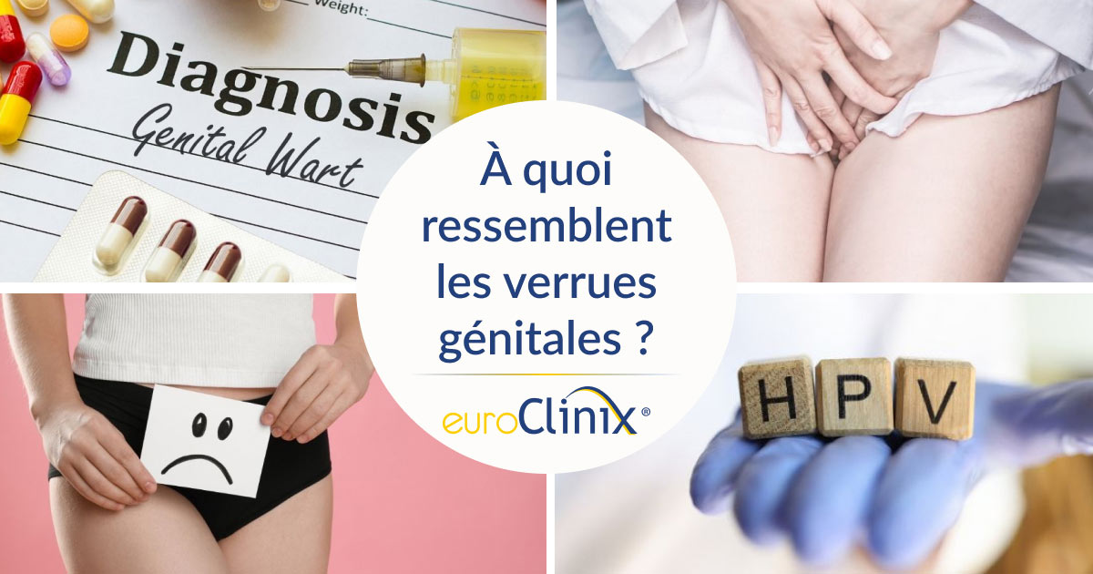 Collage image for an article titled: What do genital warts look like?