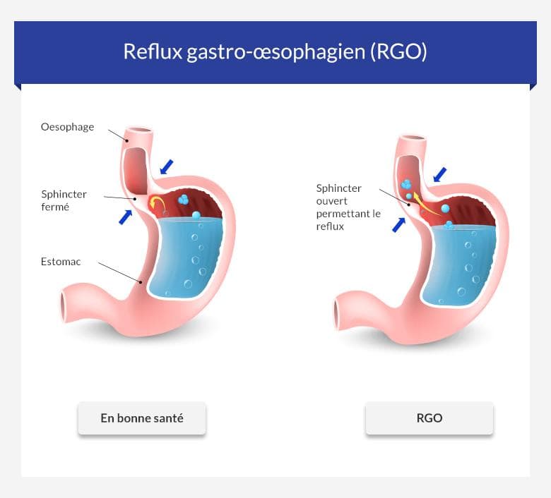 Reflux gastro-œsophagien (RGO) • euroClinix®