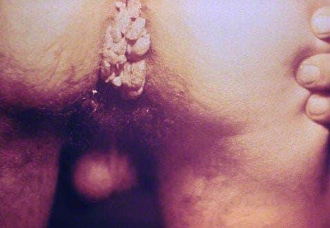Verrues génitales dans l'anus