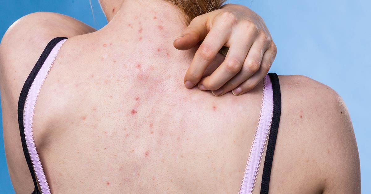 Femme souffrant d'acné dans le dos.