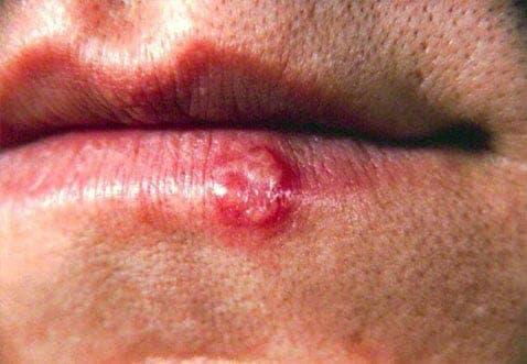 herpes simplex