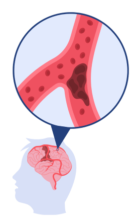 Graphique illustrant le traitement de la migraine par le Rizatriptan