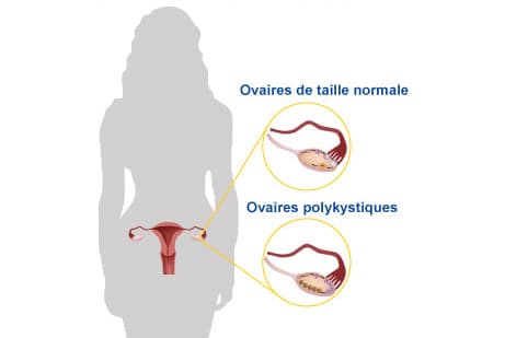 syndrome des ovaires polykistiques