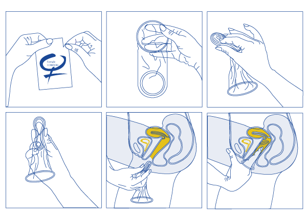 Comment utiliser un préservatif féminin