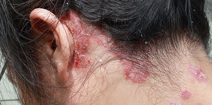 Une galerie d’images présentant les différents types de psoriasis