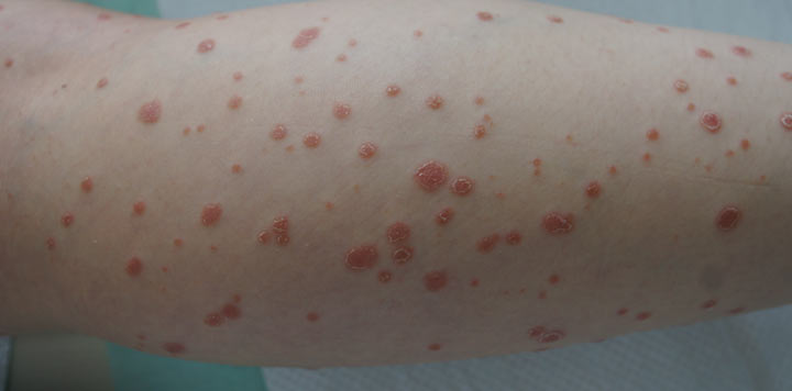 Et galleri med bilder som viser de forskjellige typene psoriasis