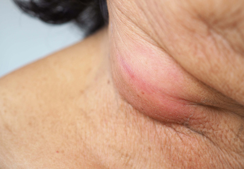 Bilde som fremhever hovne lymfeknuter i nakken, et mulig symptom på oral chlamydia