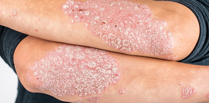 Et galleri med bilder som viser de forskjellige typene psoriasis