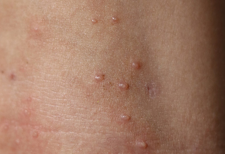 Molluscum contagiosum-virus