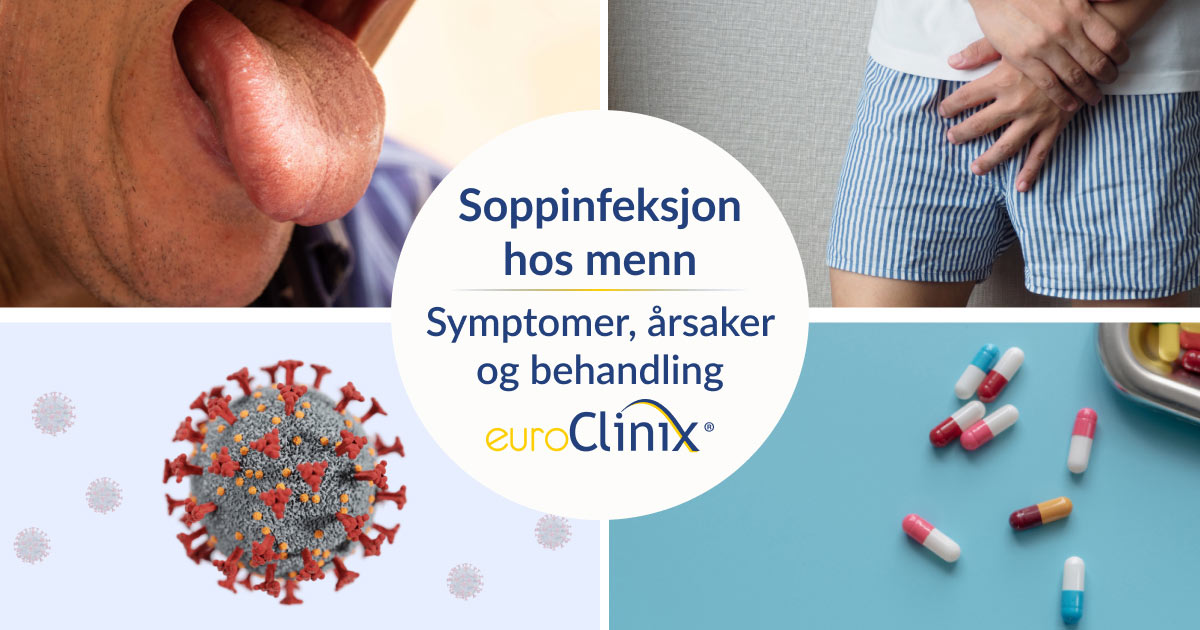 Symptomer, årsaker og behandling av soppinfeksjon hos menn