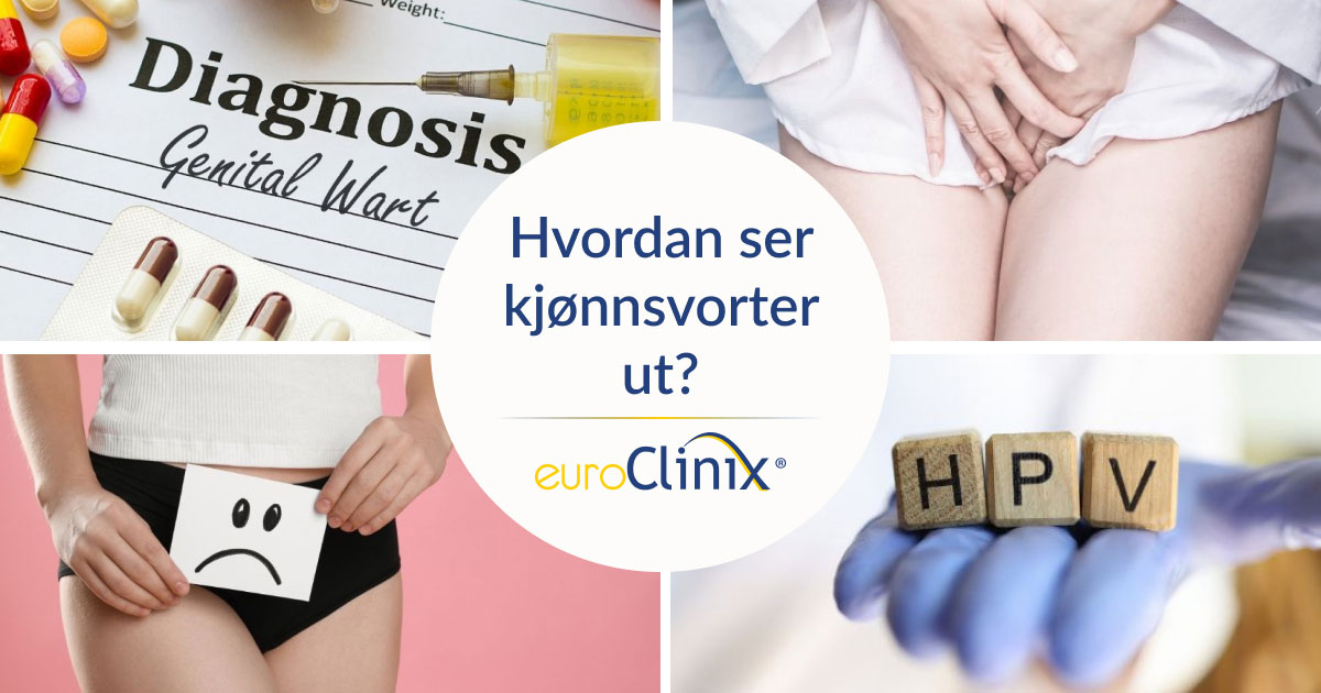 Kollasjebilde til en artikkel med tittelen: Hvordan ser kjønnsvorter ut?