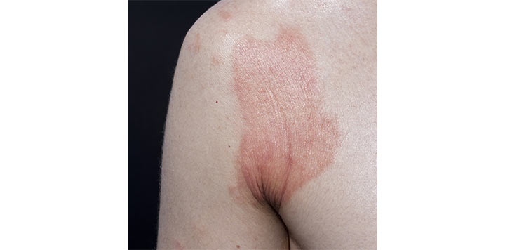 Et galleri med bilder som viser de forskjellige typene psoriasis