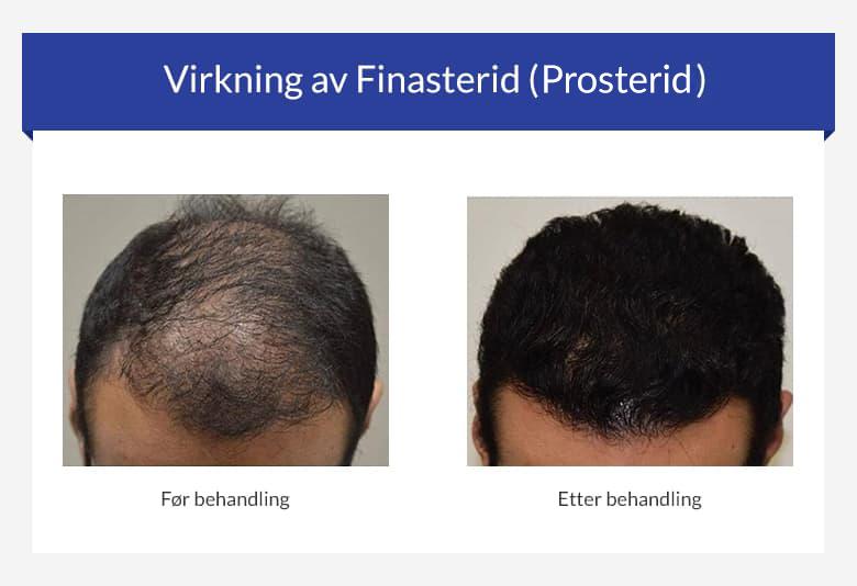 Virkning av Finasterid (Prosterid)