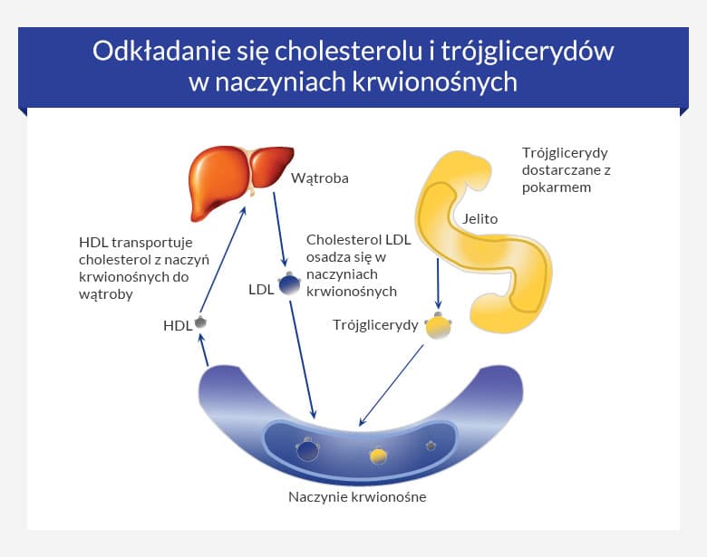 Wysoki Cholesterol • Kup Statyny Na Obniżenie Cholesterolu Bez Recepty 1133