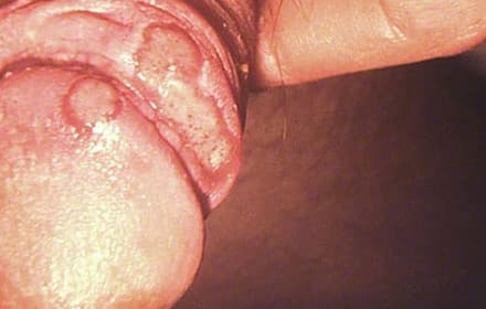Genital herpes due to HSV-2 on the penis','Genital herpes due to HSV-2 on the penis