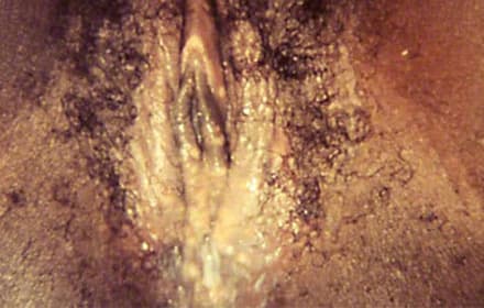 Genital herpes due to HSV-2