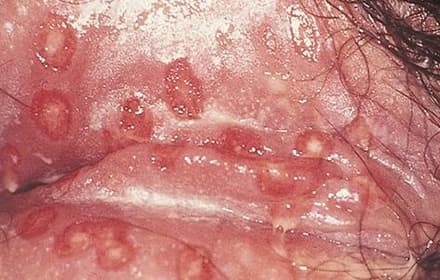 Genital herpes due to herpes simplex virus 2
