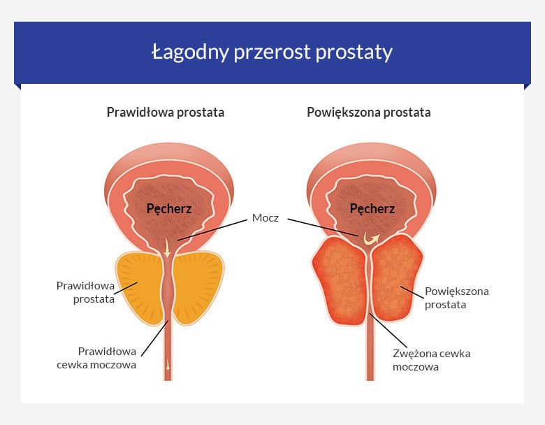 Co oznacza łagodny przerost prostaty (BPH)?