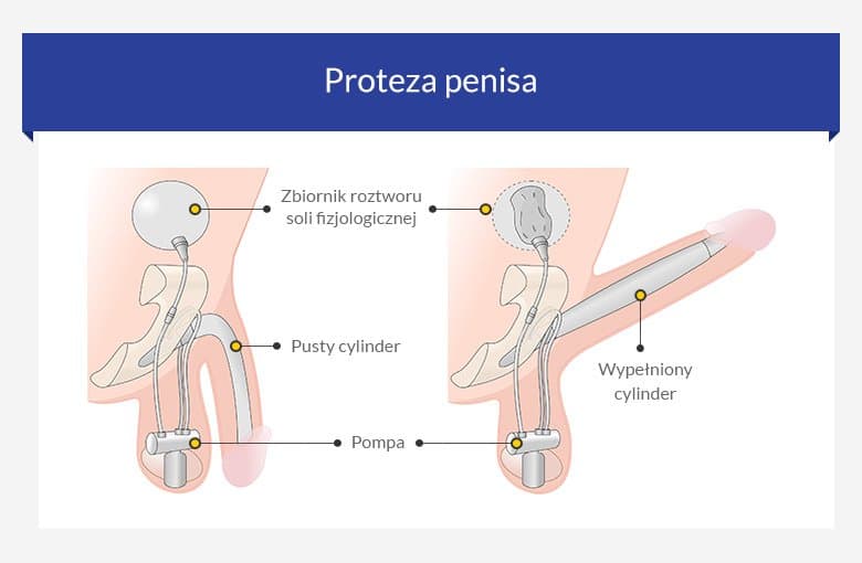erekcja i sok prostaty