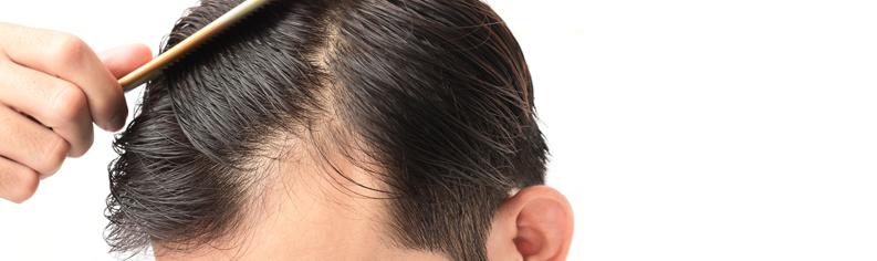 Młody mężczyzna z cofającą się linią włosów zaczesuje włosy do tyłu