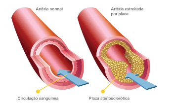 Aterosclerose Disfunção Erétil