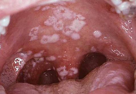 Imagem em detalhe de uma garganta com placas brancas nas amígdalas, que podem indicar clamídia oral ou outra infeção.